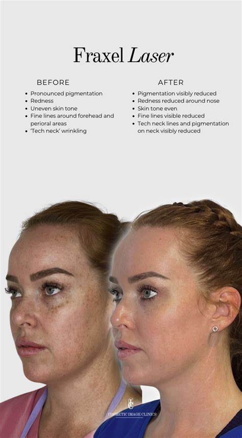 9 Fraxel Laser doctors & clinics in Singapore .